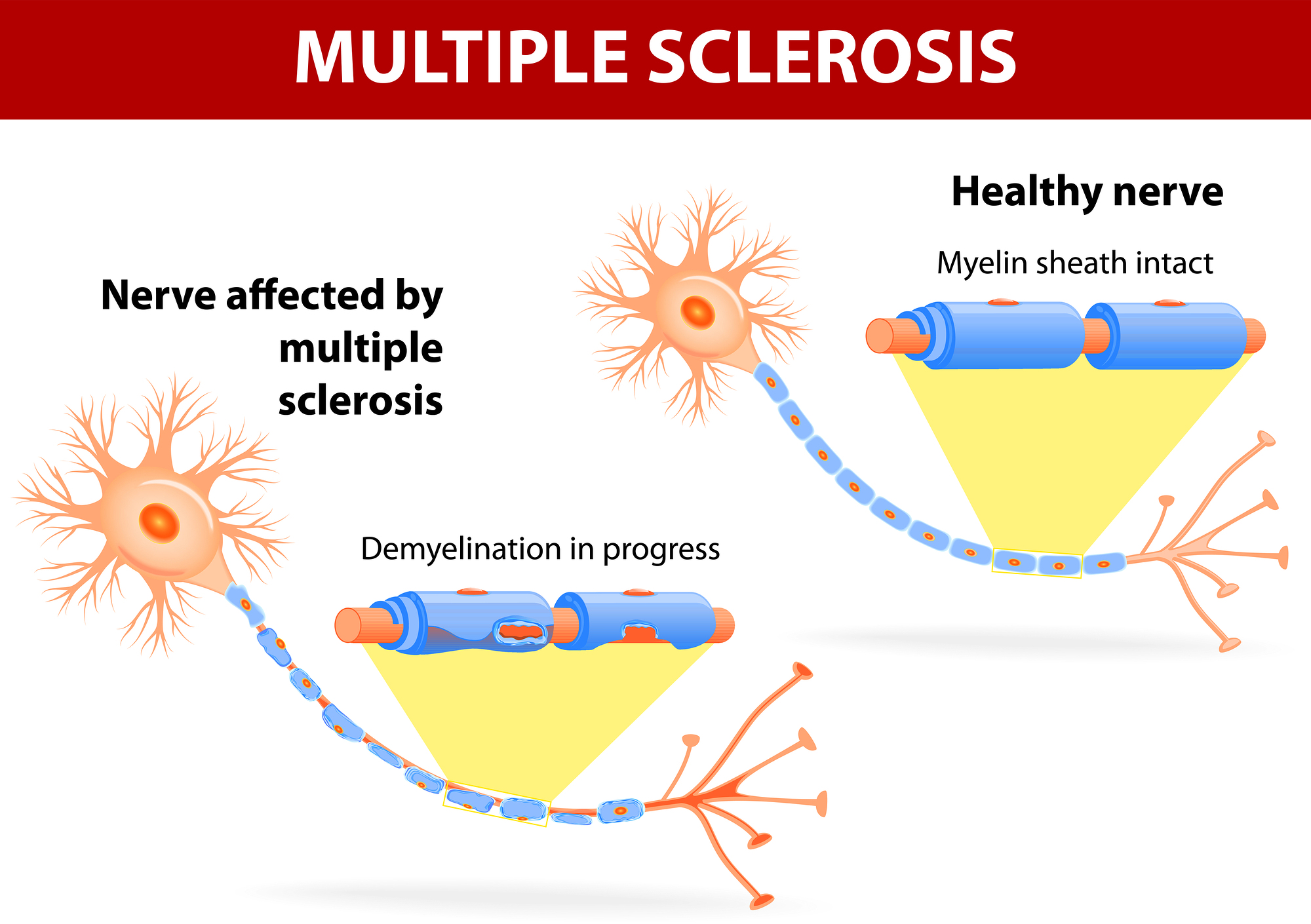 Natural Relief For Symptoms Of Multiple Sclerosis In Sacramento Body 