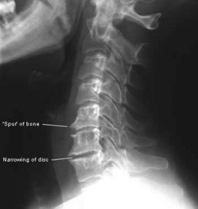 Whiplash leads to early Onset arthritis